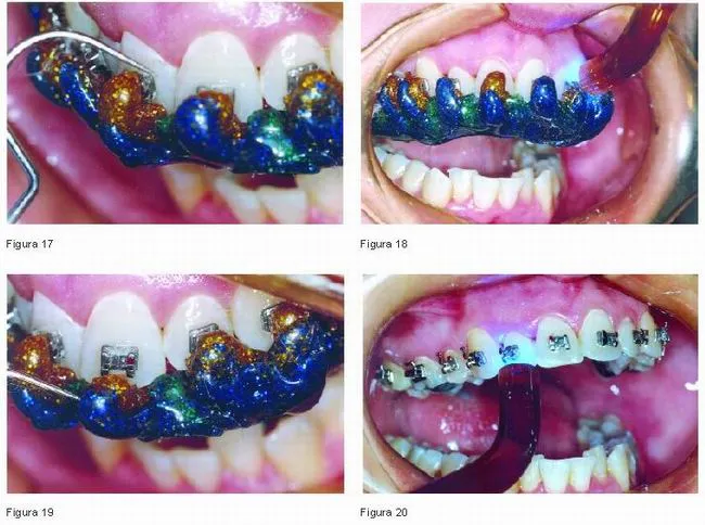 Adhesión indirecta en Ortodoncia | Gaceta Dental