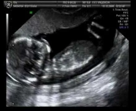 Imágenes de ecografías de 3 meses de embarazo - Imagui