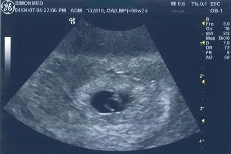 Cinco semanas de embarazo - Imagui