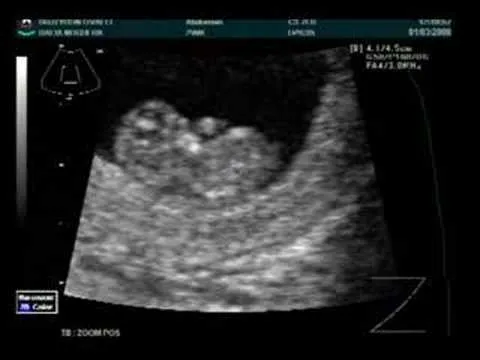 Ultrasonido de bebé 2 meses - Imagui