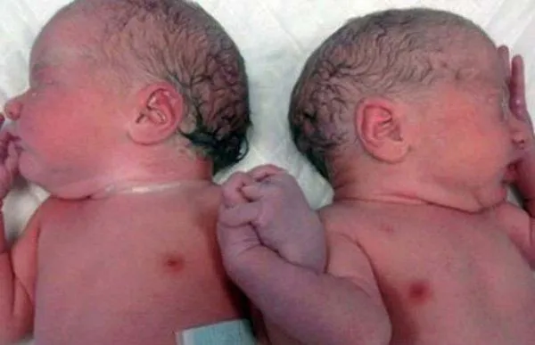 Insólita imagen de los mellizos que se dan la mano tras nacer