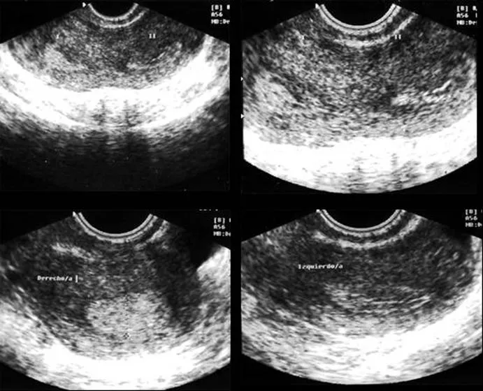 Malformaciones uterinas (página 2) - Monografias.