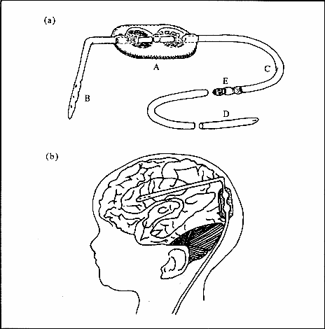  para el tratamiento de hidrocefalia y su colocación en cerebro ...