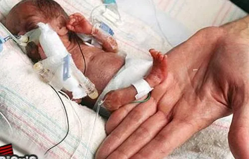 Menor bebê prematuro do país terá alta amanhã | Prematuridade.com