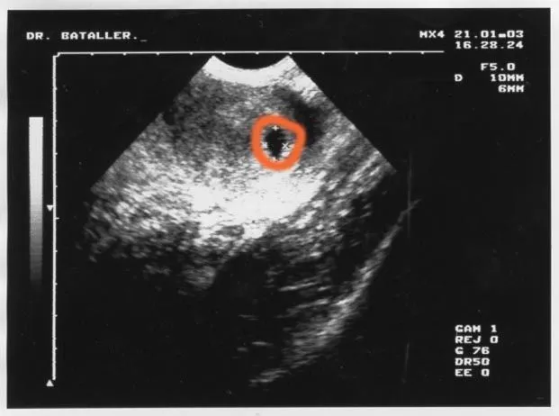 SEGUNDO MES: de embarazo se forman los ojos del embrión y empiezan a ...