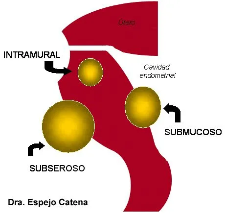 Miomatosis | MEDICINA DE LA REPRODUCCIÓN: esterilidad ...