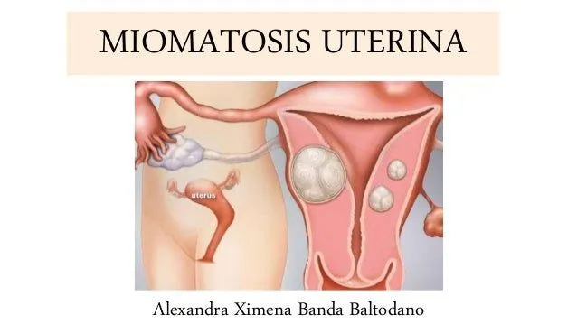 Miomatosis uterina