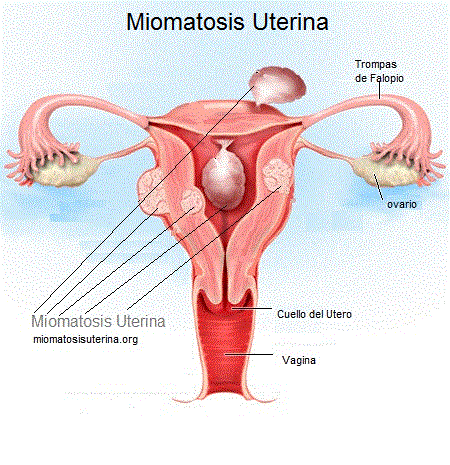 Miomatosis Uterina | Dr. Rodriguez, Su Ginecólogo Amigo