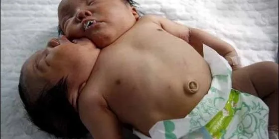 Nace en China un recién nacido con dos cabezas :: Salud ...