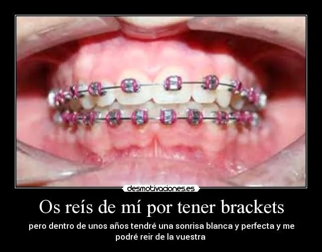 Nεkσ ♥: LAS CHICAS CON BRACKETS TAMBIEN TENEMOS SENTIMIENTOS! QUE ...