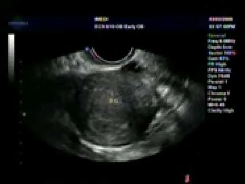 Nossa primeira Ultrassonografia, + ou - 4 Semanas - YouTube