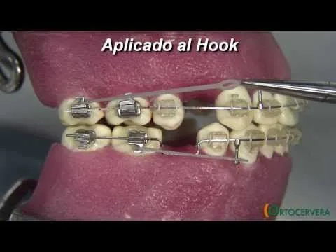 ORTOCERVERA / Ortodoncia: Asas en U - Compensación Oclusal ...