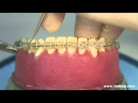 Ortodoncia con Mini Brackets. MedellínOralimagen