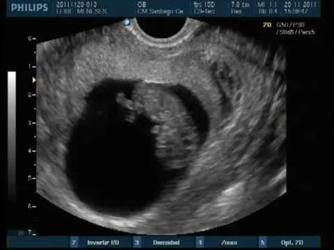 Popular Videos - Ultrasonography and Fetus PlayList
