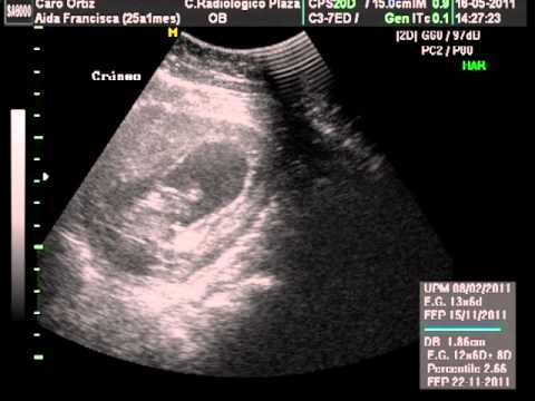 Primeras imagenes de nuestro bebé!!! 11 semanas 6 dias! - YouTube