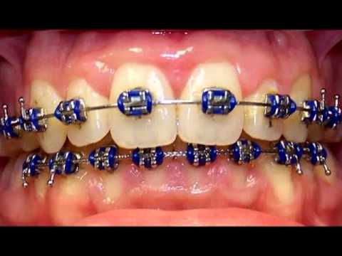 Quieres usar Brackets? - YouTube