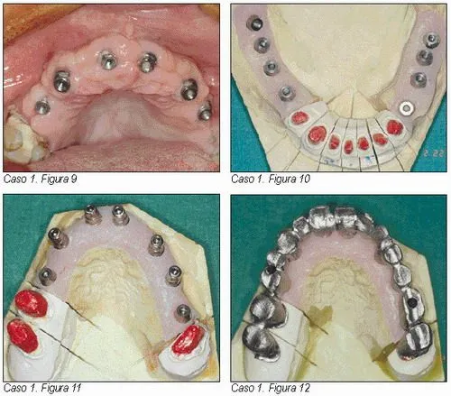 Rehabilitación oral combinando implantes y dientes | Gaceta Dental