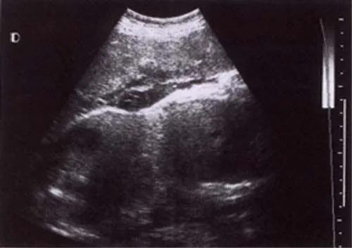 Ultrasonido de gemelos de 3 meses - Imagui