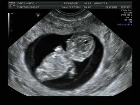 Semana 11 de embarazo ecografia - Imagui