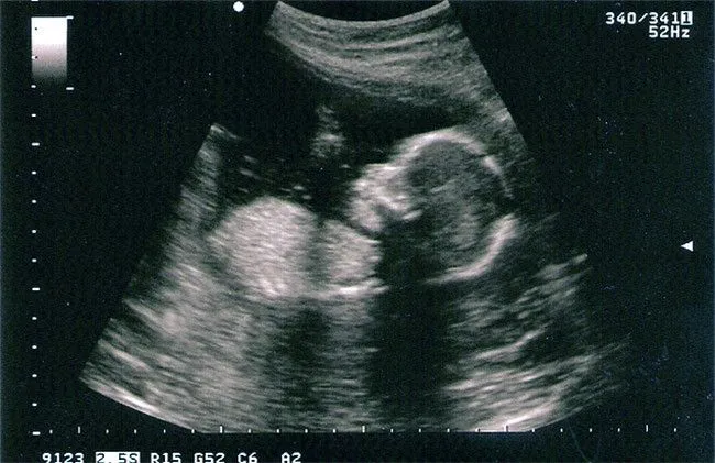 Semana 18 de embarazo