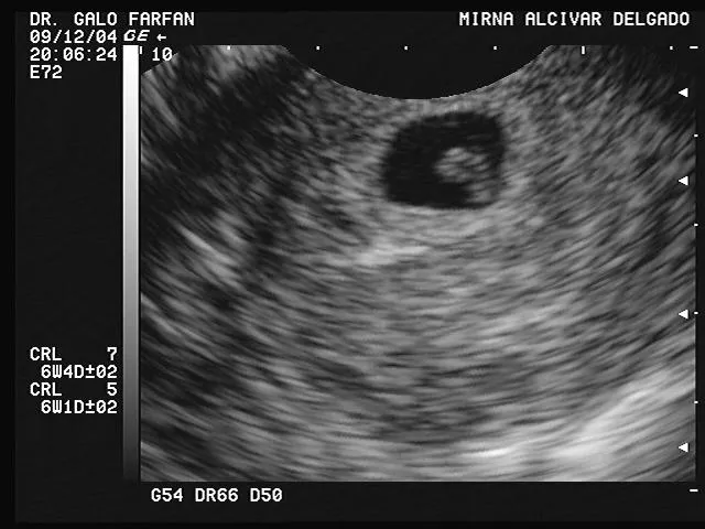 6 semana de embarazo ecografia - Imagui
