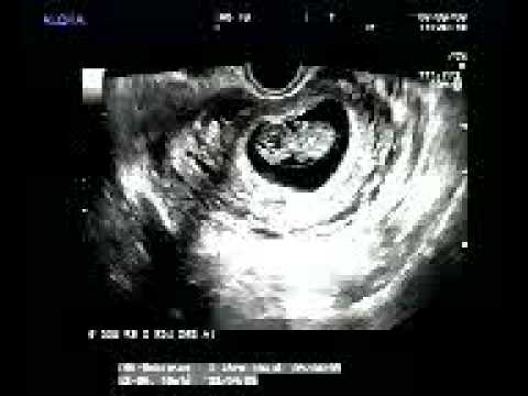 2 semanas embarazo Claudia - YouTube