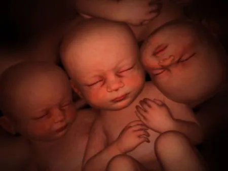 Singular embarazo de trillizos idénticos