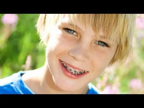 Tipos de aparatos de ortodoncia para los niños - YouTube