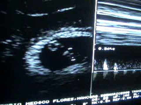 Transvaginal Ultrasound Pregnancy 6.4 weeks- Ultrasonido ...