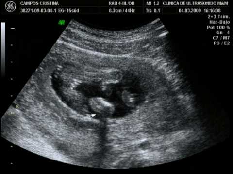 Ultrasonido de 3 meses de embarazo niña - Imagui