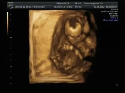 Ultrasonido 17 semanas de embarazo. Es niña! - YouTube