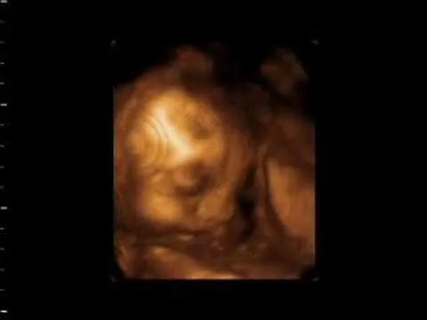 Ultrasonido en 3D: bebe Torres Zuñiga. 4 de marzo, 2006 - YouTube