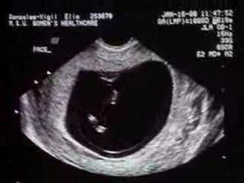 Ultrasonido de bebe a las 10 semanas - YouTube