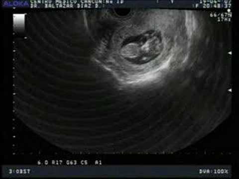 Ultrasonido bebe - 12 semanas - YouTube