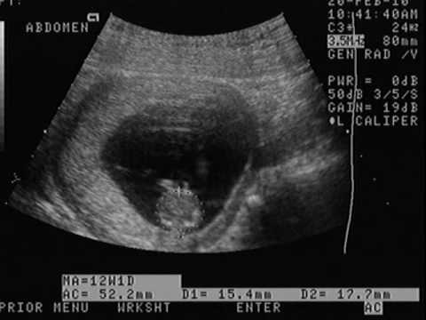 ultrasonido bebe 13 semanas 3 dias ► HTML5 Video
