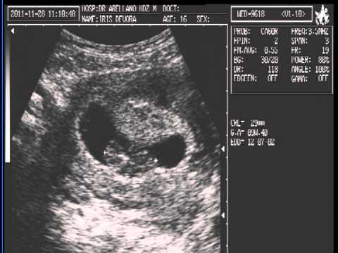 ultrasonido de mi bebé alos 2 meses :$ te amo - YouTube