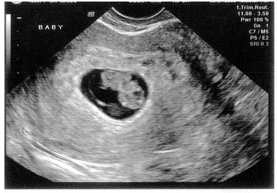 Ultrasonidos de bebés de 1 mes - Imagui