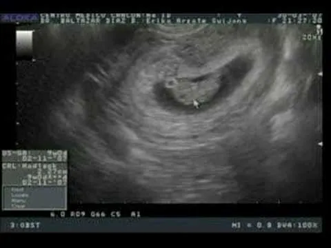 Ultrasonido bebe - 9 semanas - YouTube