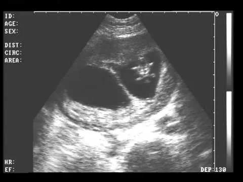 Ultrasonidos de gemelos de 7 semanas - Imagui