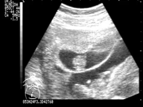 Ultrasonido Embarazo Gemelar 10 semanas - YouTube