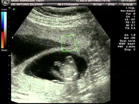 Ultrasonido Gemelar 13 semanas - YouTube