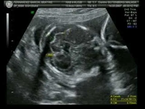  ... hacerte el ultrasonido y a ver dos pequenos fetos apenas formandose