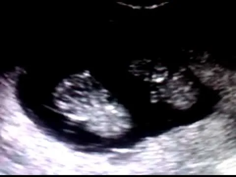 Ultrasonido de gemelos de 2 meses - Imagui