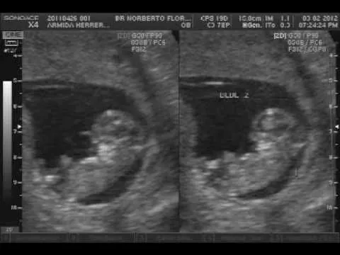 Imagenes de ultrasonidos de gemelos de 4 meses - Imagui