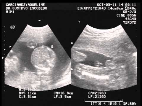 Ultrasonido Gemelos 5 meses - YouTube