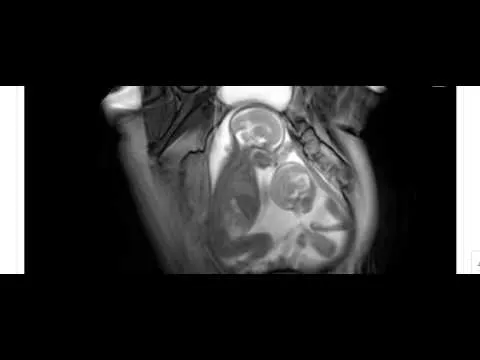 Ultrasonido de gemelos que se pelean en el utero de la madre - YouTube