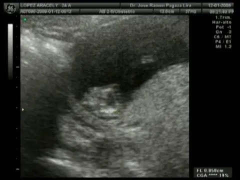 Ultrasonido de mi hernoso bebe a 4 meses y medio de embarazo - YouTube