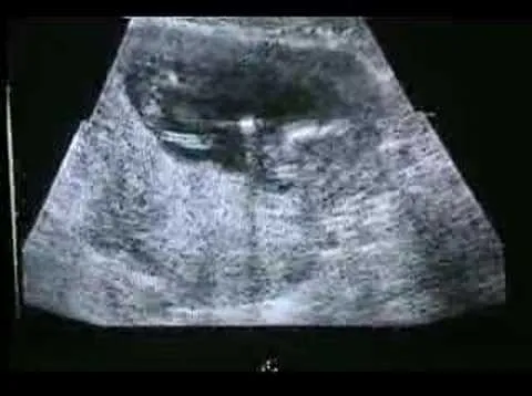 Ultrasonido de mi hijo a los 3 meses de embarazo - YouTube
