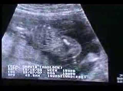 Ultrasonido de mi hijo a los cuatro meses de embarazo - YouTube