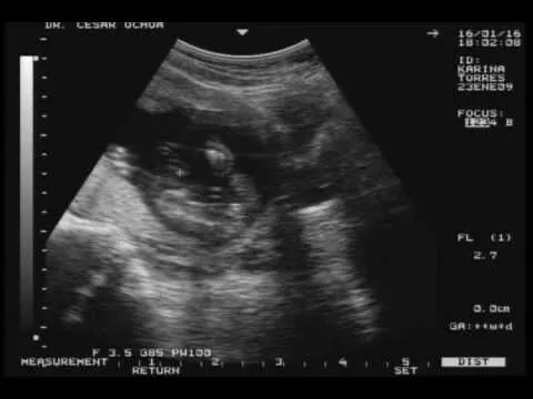Ultrasonido de un mes de embarazo - Imagui